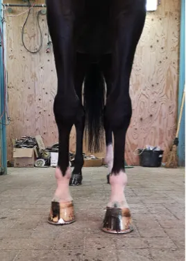 Varus du pied antérieur gauche, léger varus du pied antérieur droit avec rotation interne